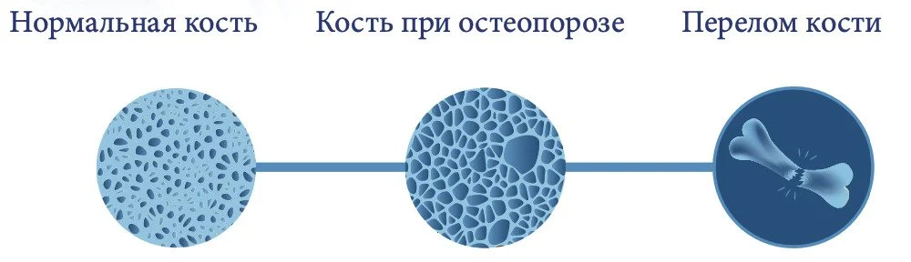 Формирование сильных костей у детей и подростков — изображение 2